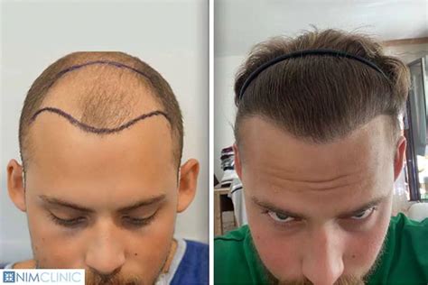 top rated hair transplant turkey.